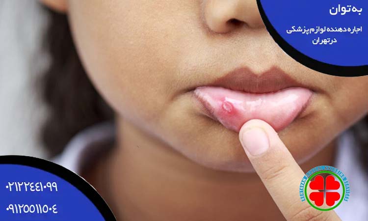استفاده از ژل‌ یا داروهای آفت دهانی کودکان